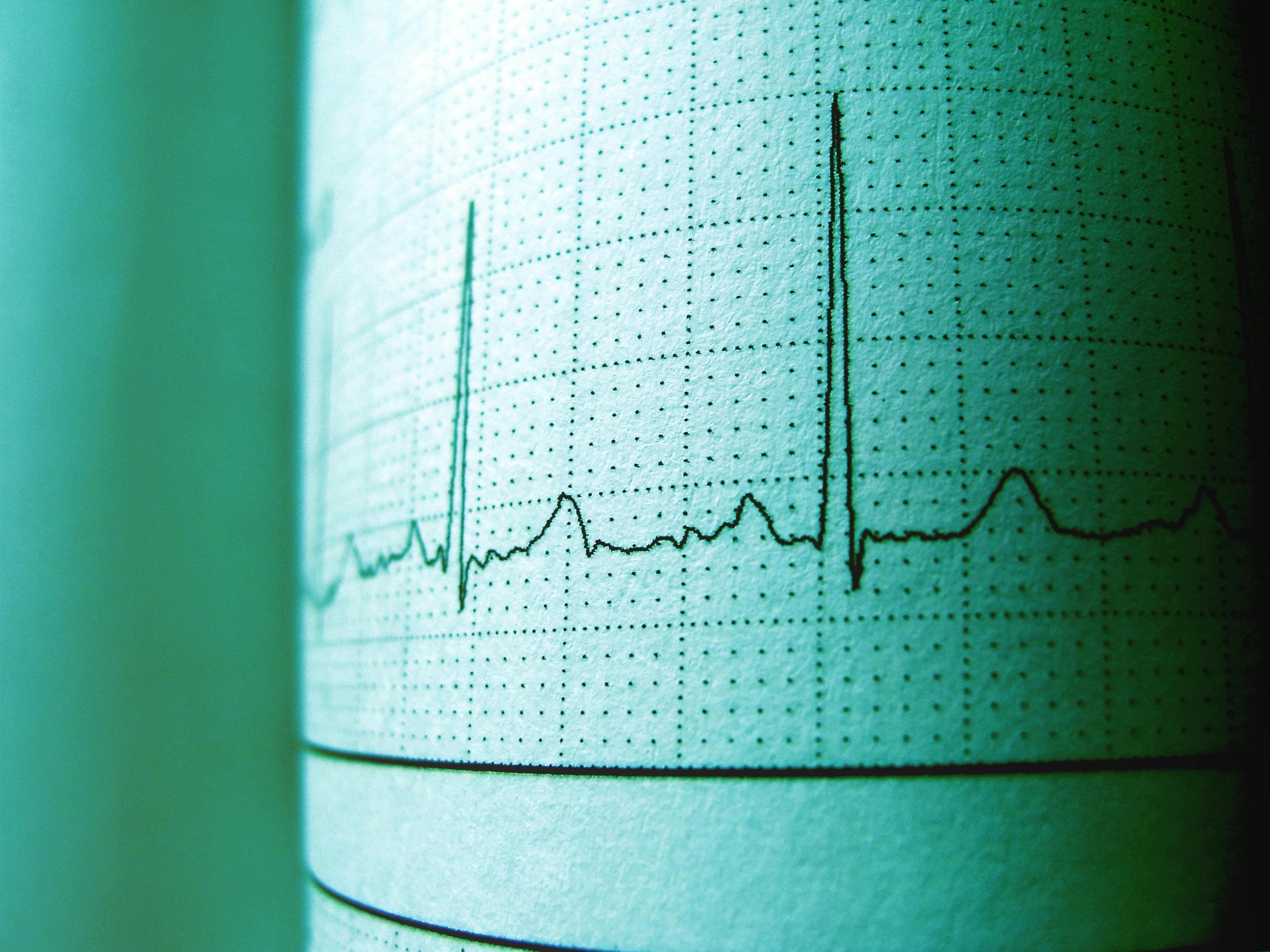 Graph showing heart rate variability before and after ablation