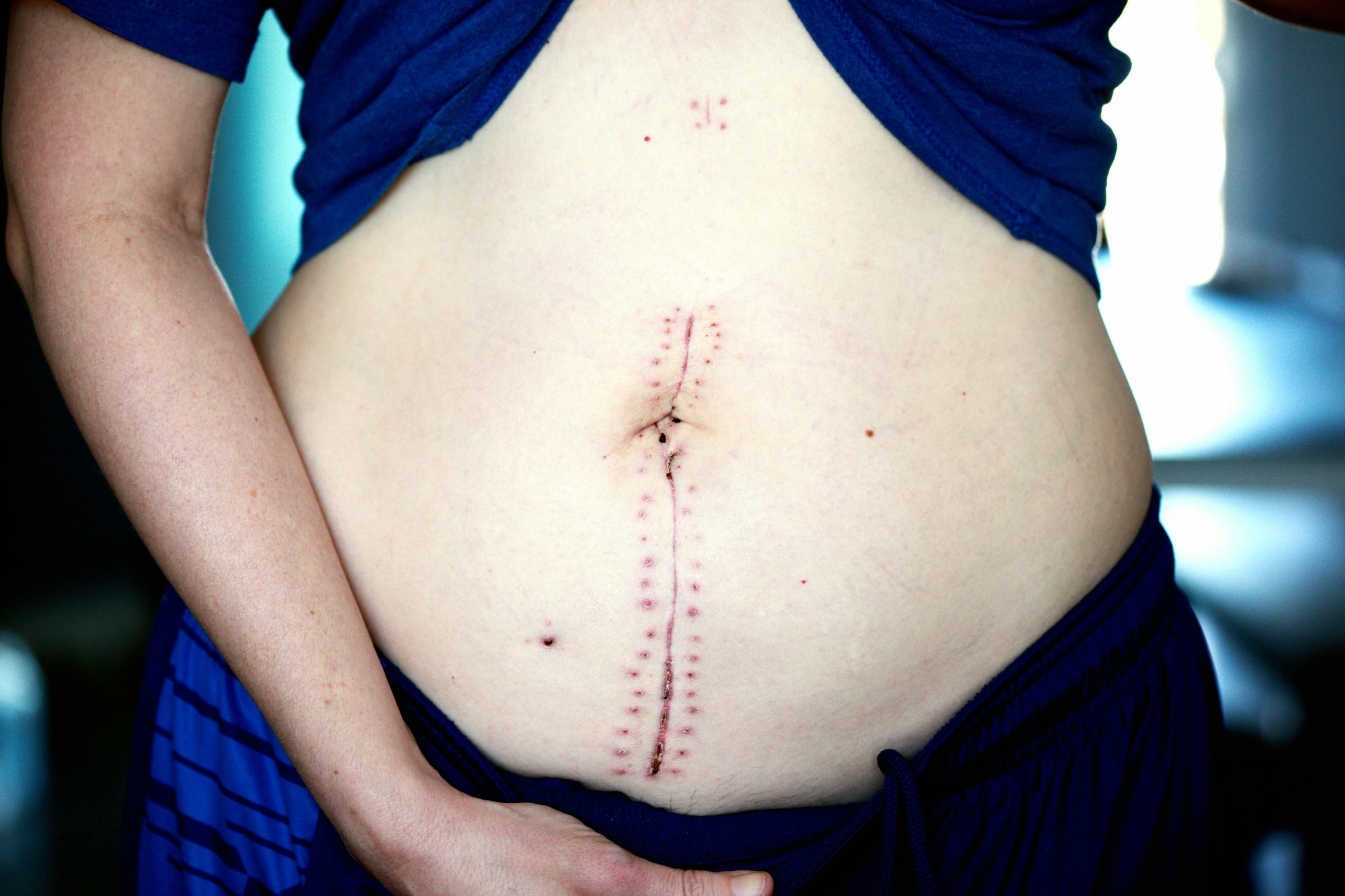 Diagram showing a stomach before and after gastric sleeve surgery
