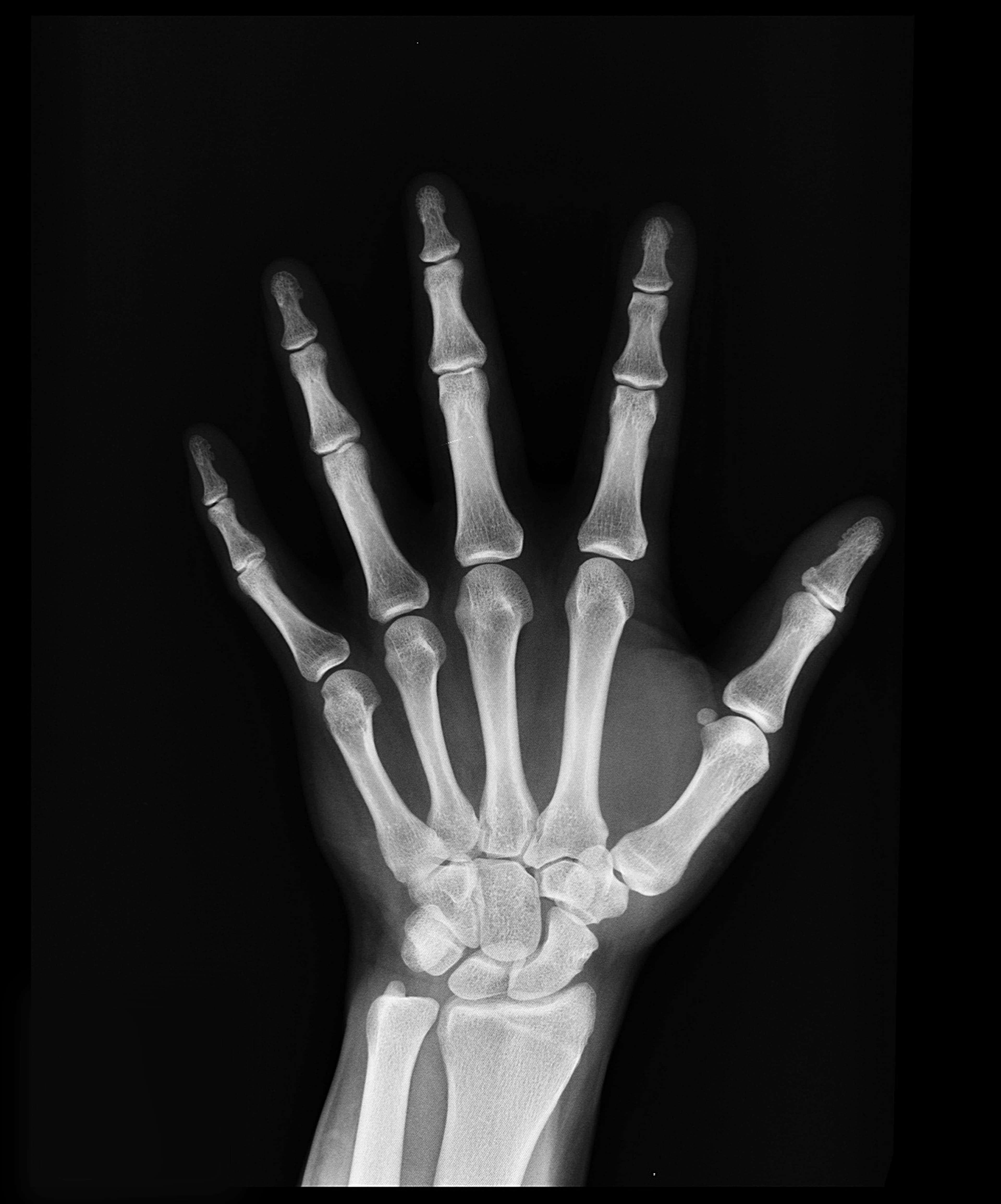 X-ray image showing positive ulnar variance in the wrist joint