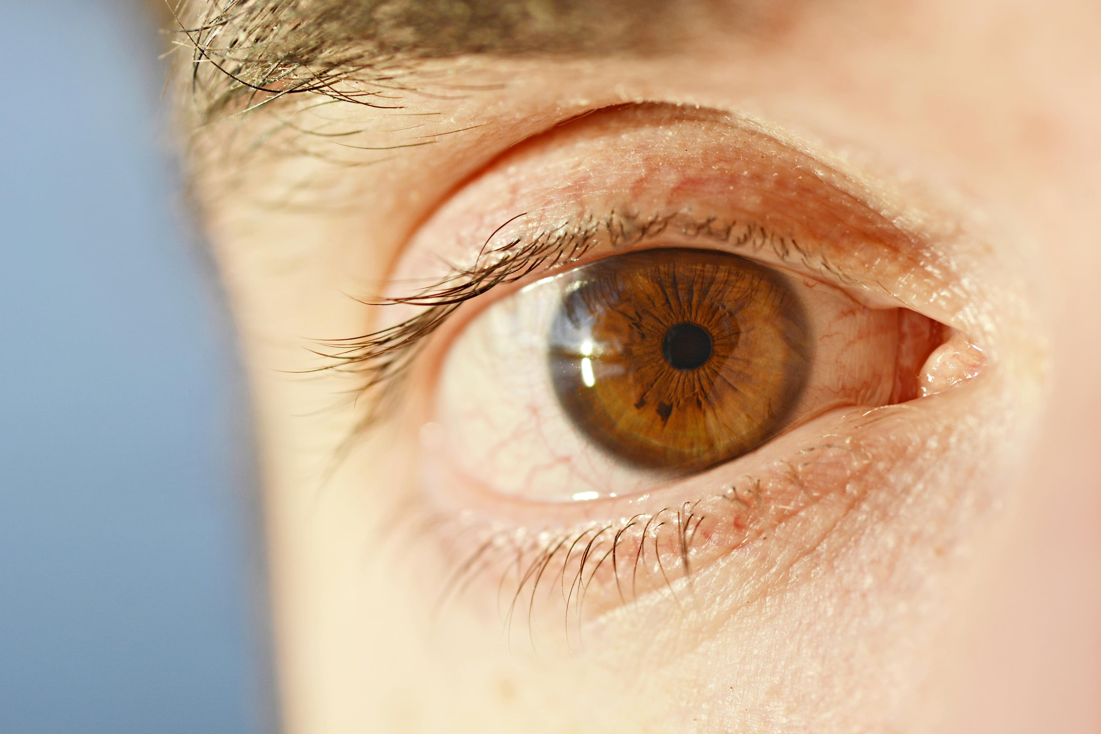 Diagram of an eye showing common locations for brown spots including the iris, sclera, and retina