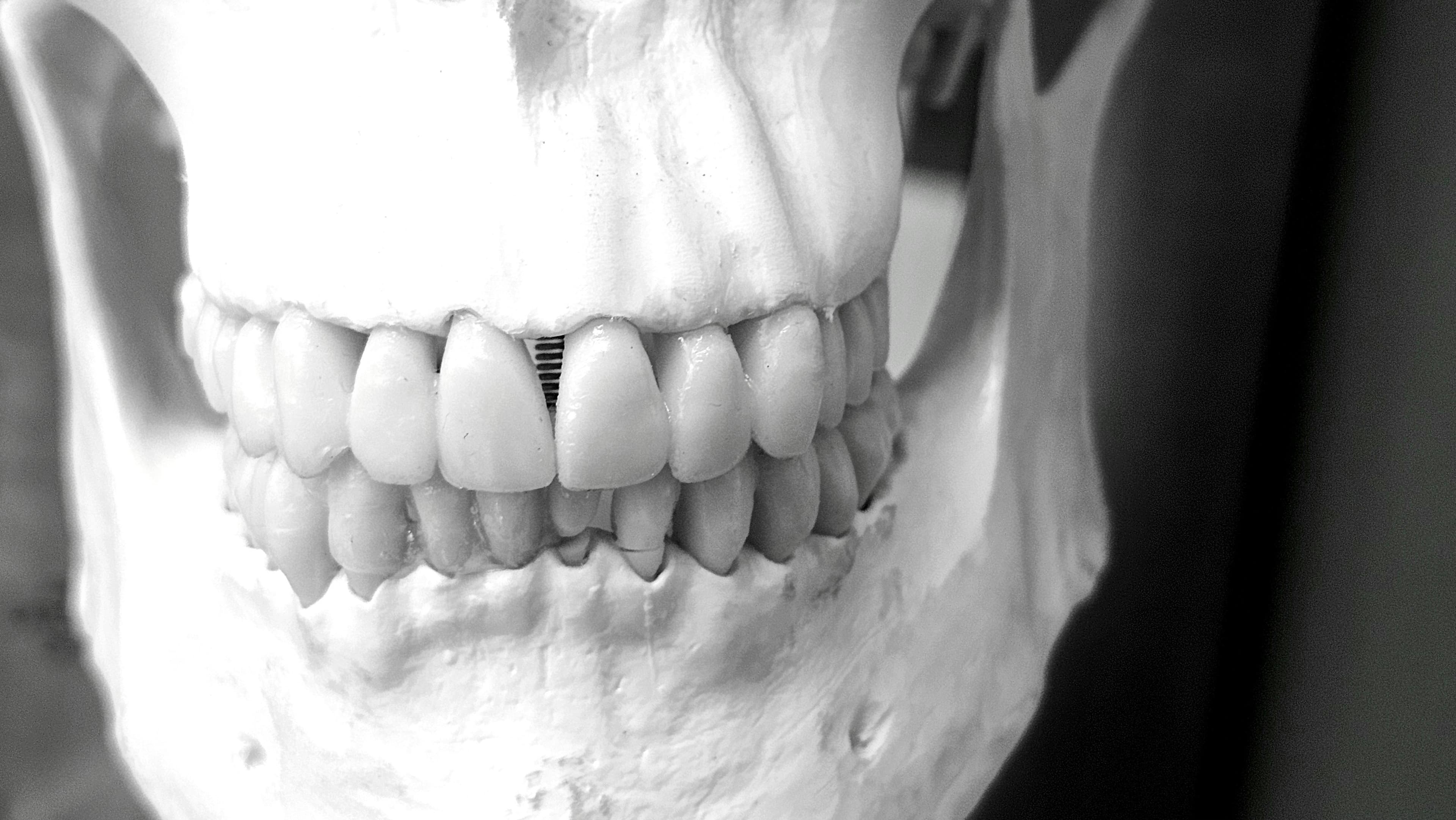 Oral surgeon performing a complex molar extraction