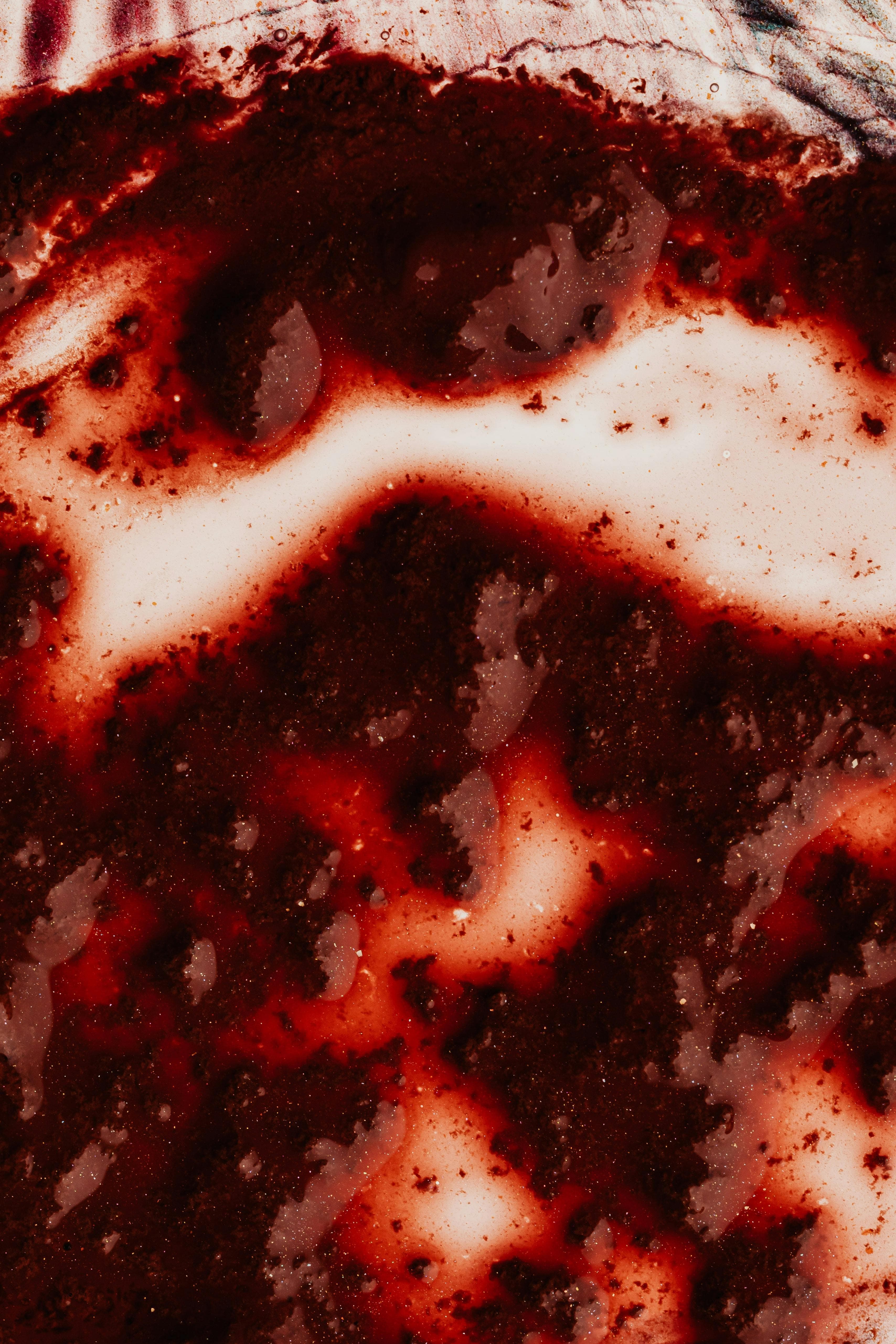 A close-up of a toenail with a dark spot underneath, indicating a hematoma