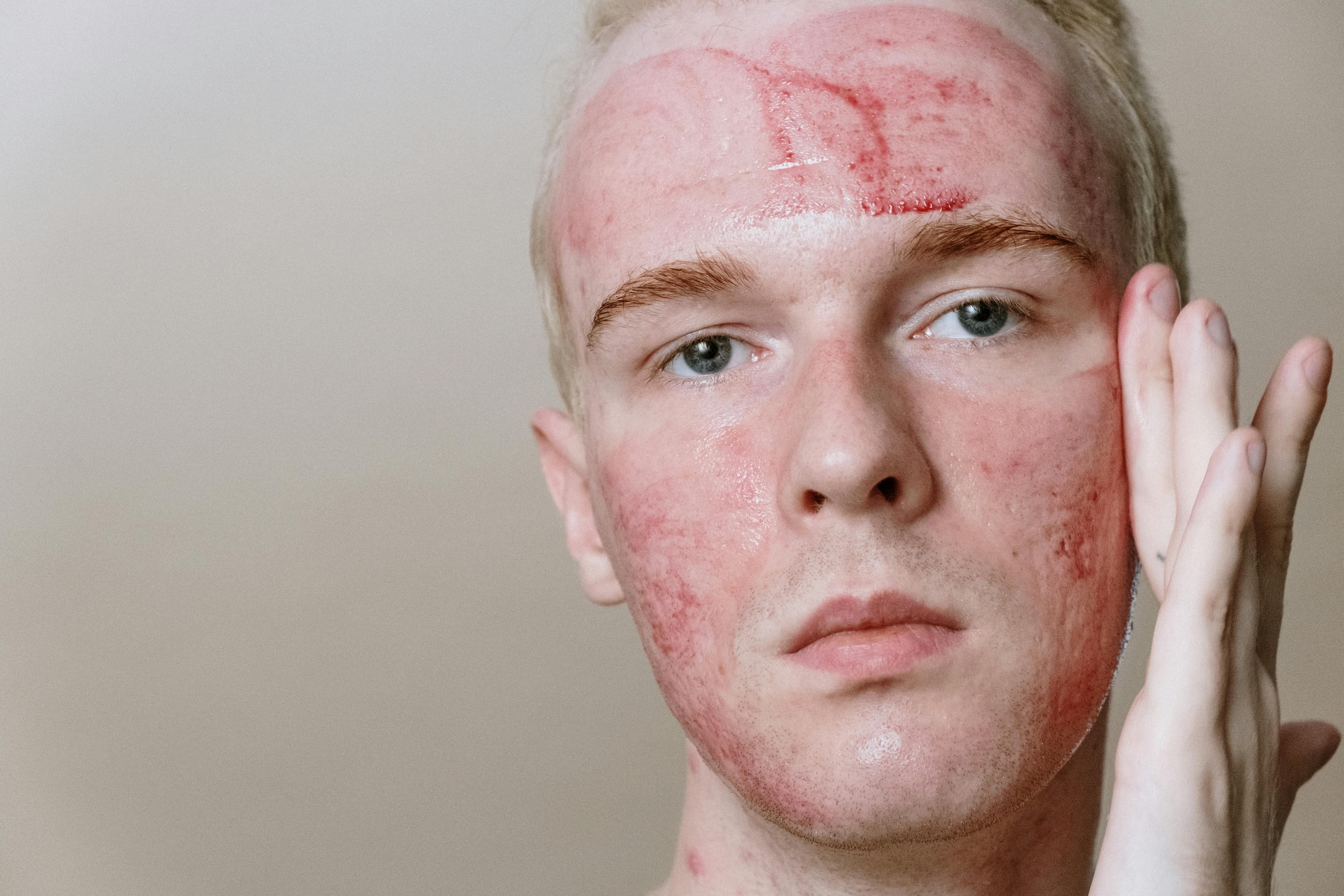 Various acne treatment products and a dermatologist examining a patient's skin