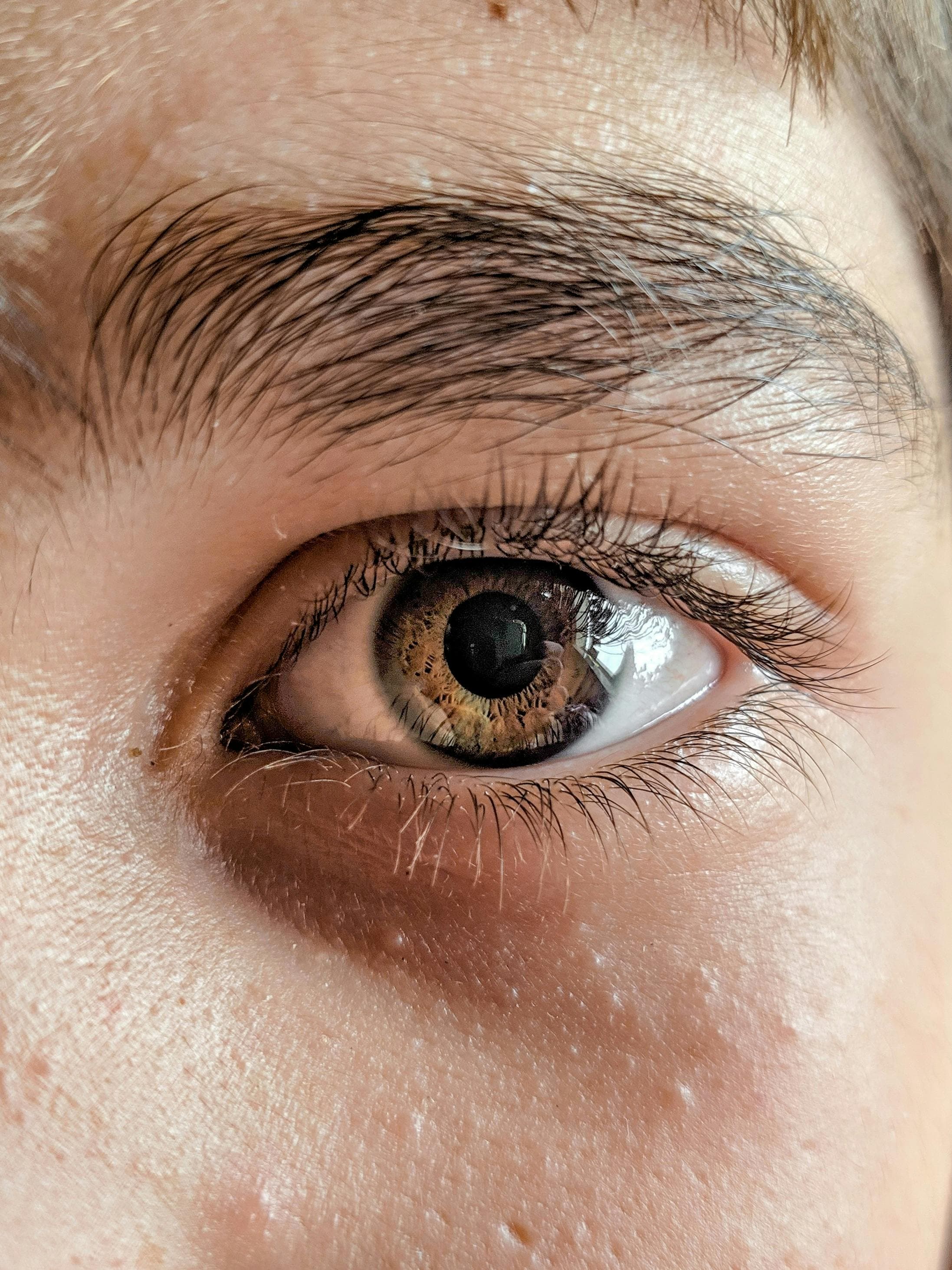 A close-up of an eye with ptosis, showing a drooping upper eyelid