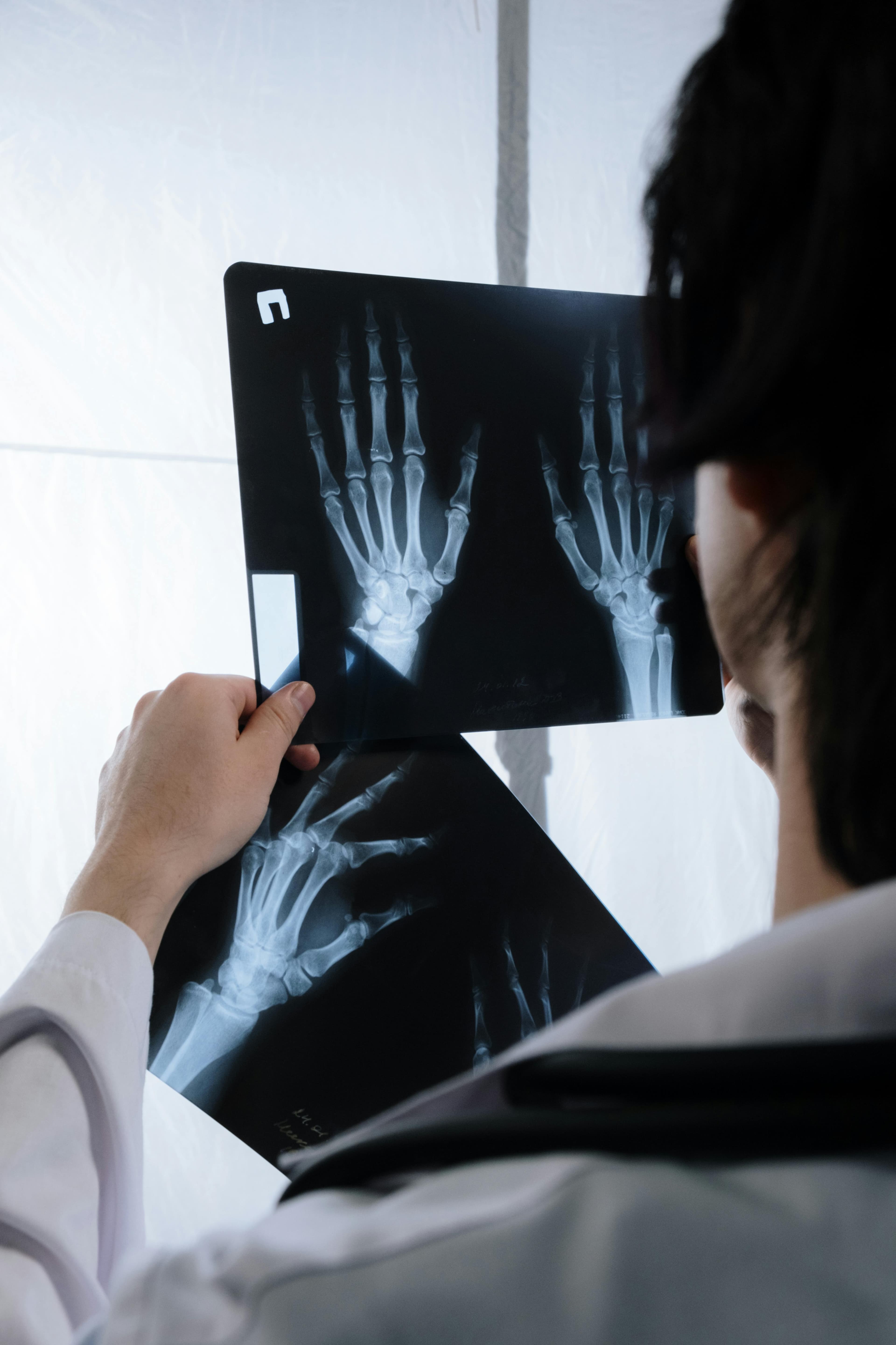 X-ray image of a fractured ankle showing the bone structure and fracture line