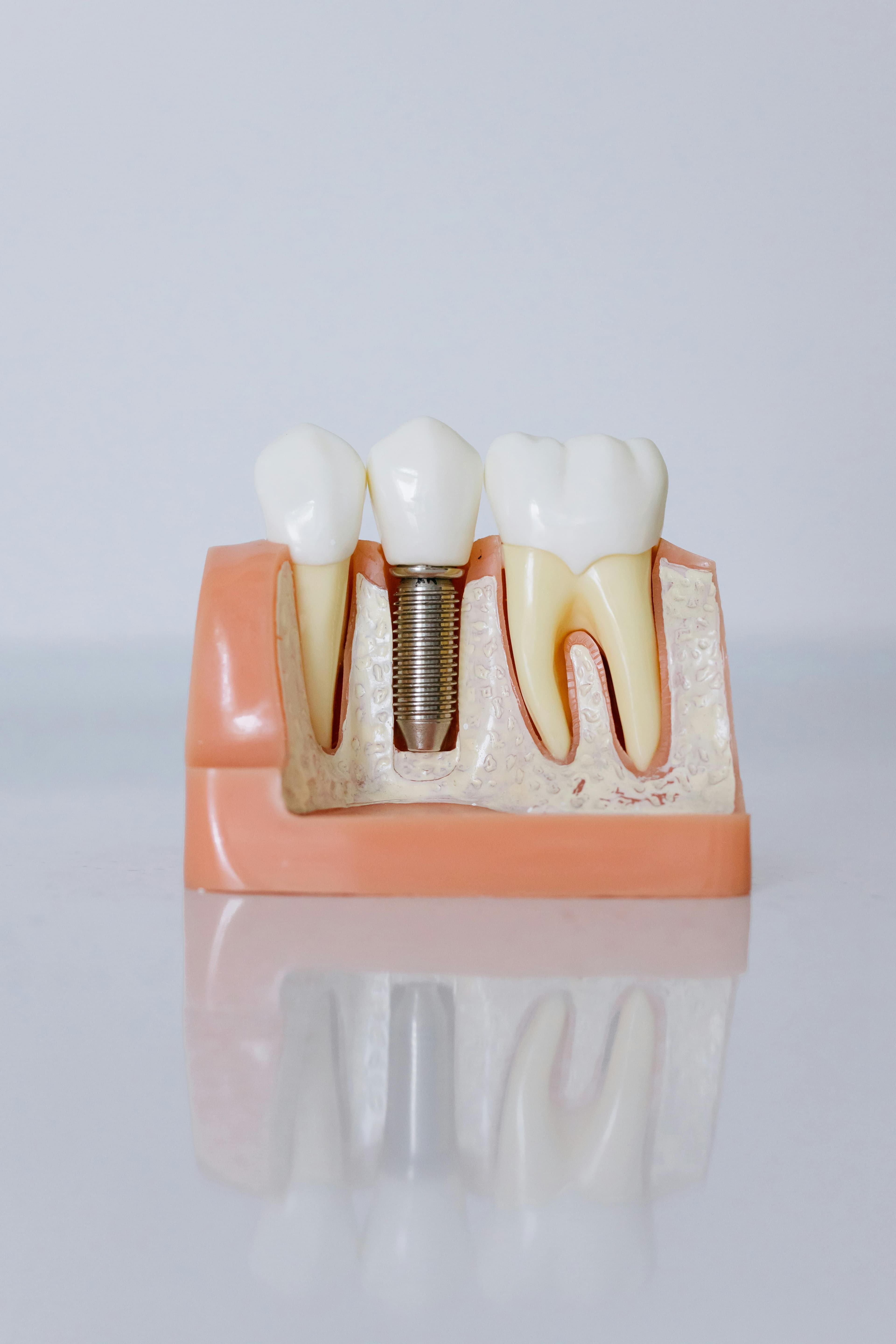 A zirconia dental implant next to a natural tooth model