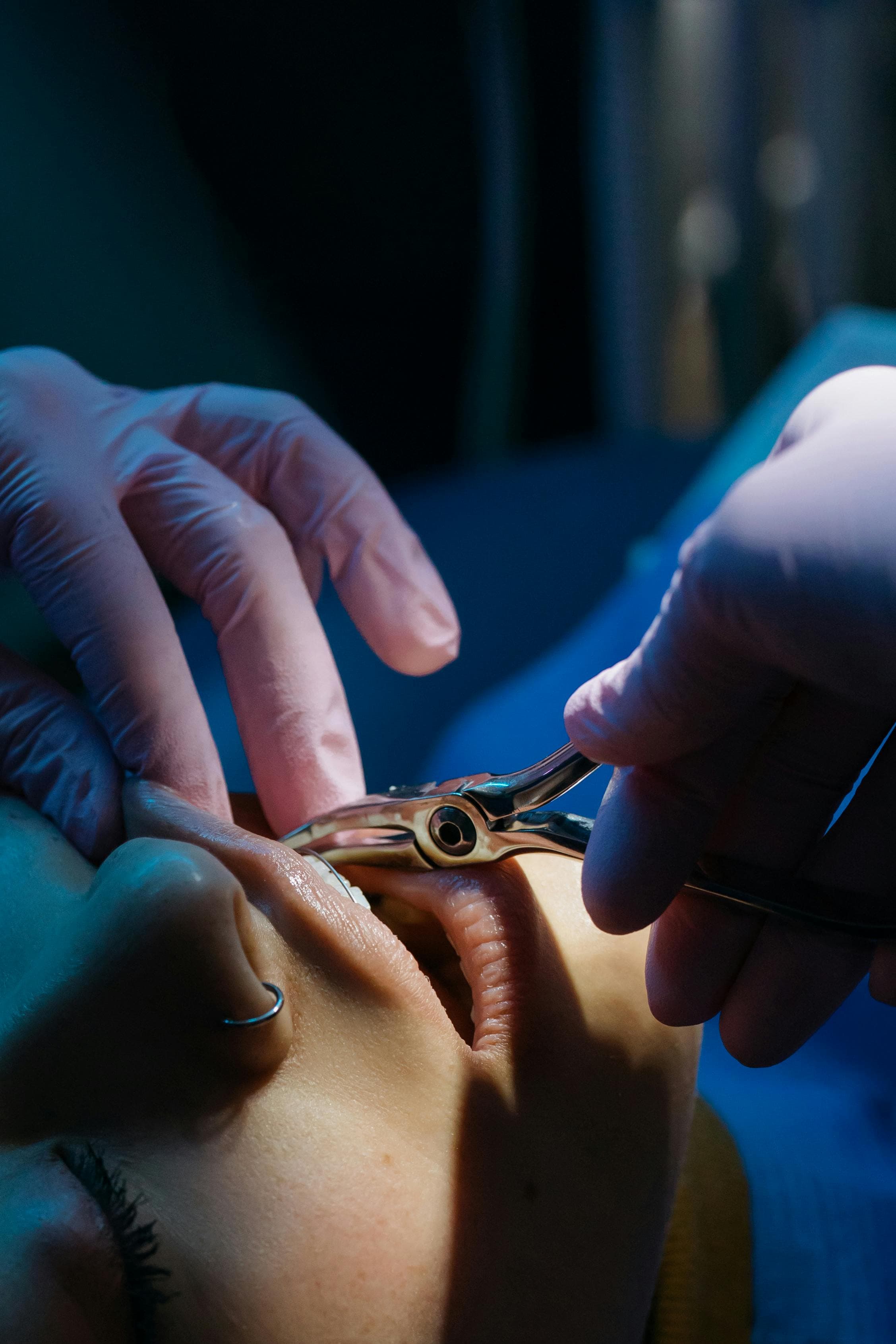 Dentist performing a simple tooth extraction on a patient