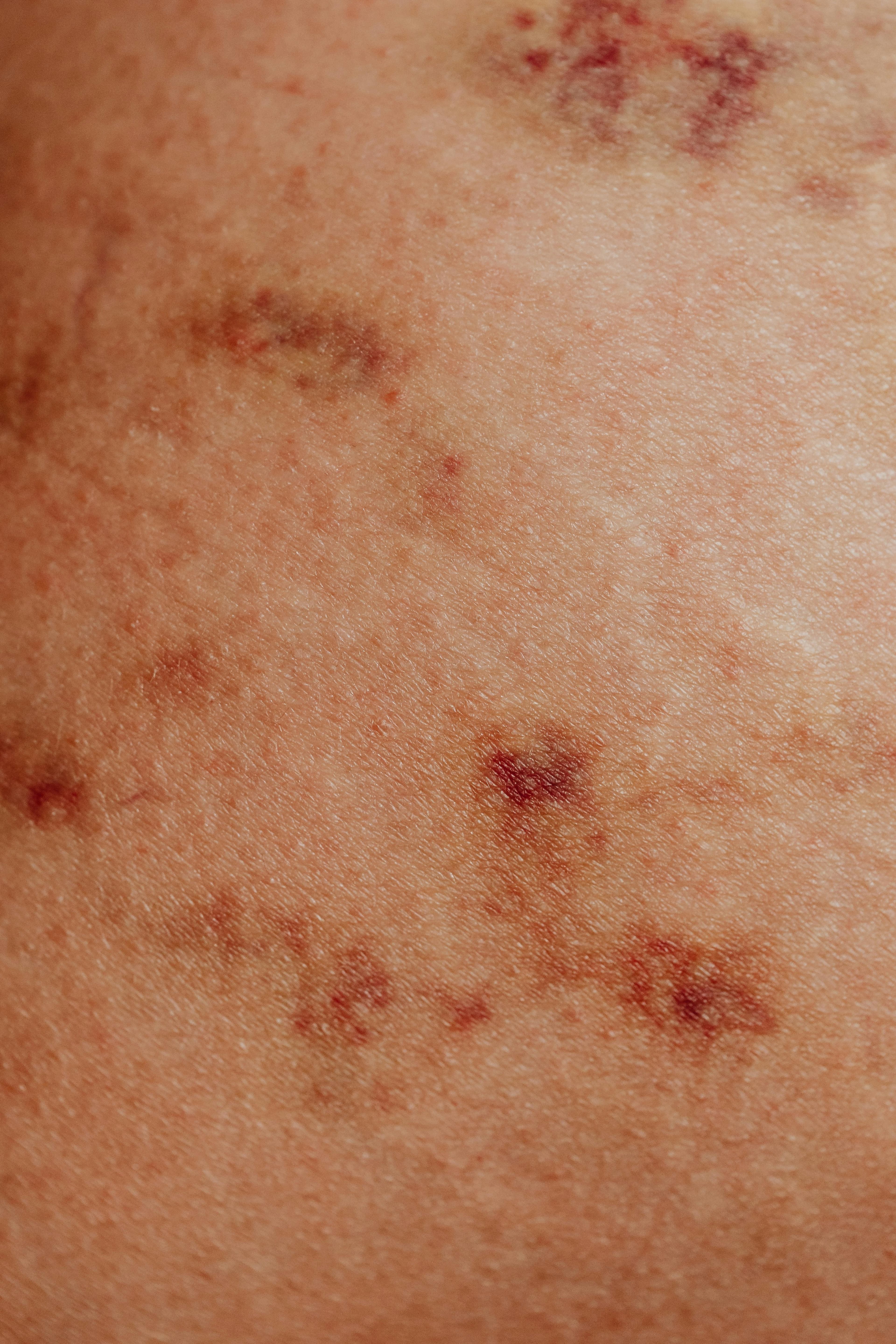 Close-up of hives on skin showing raised, red welts