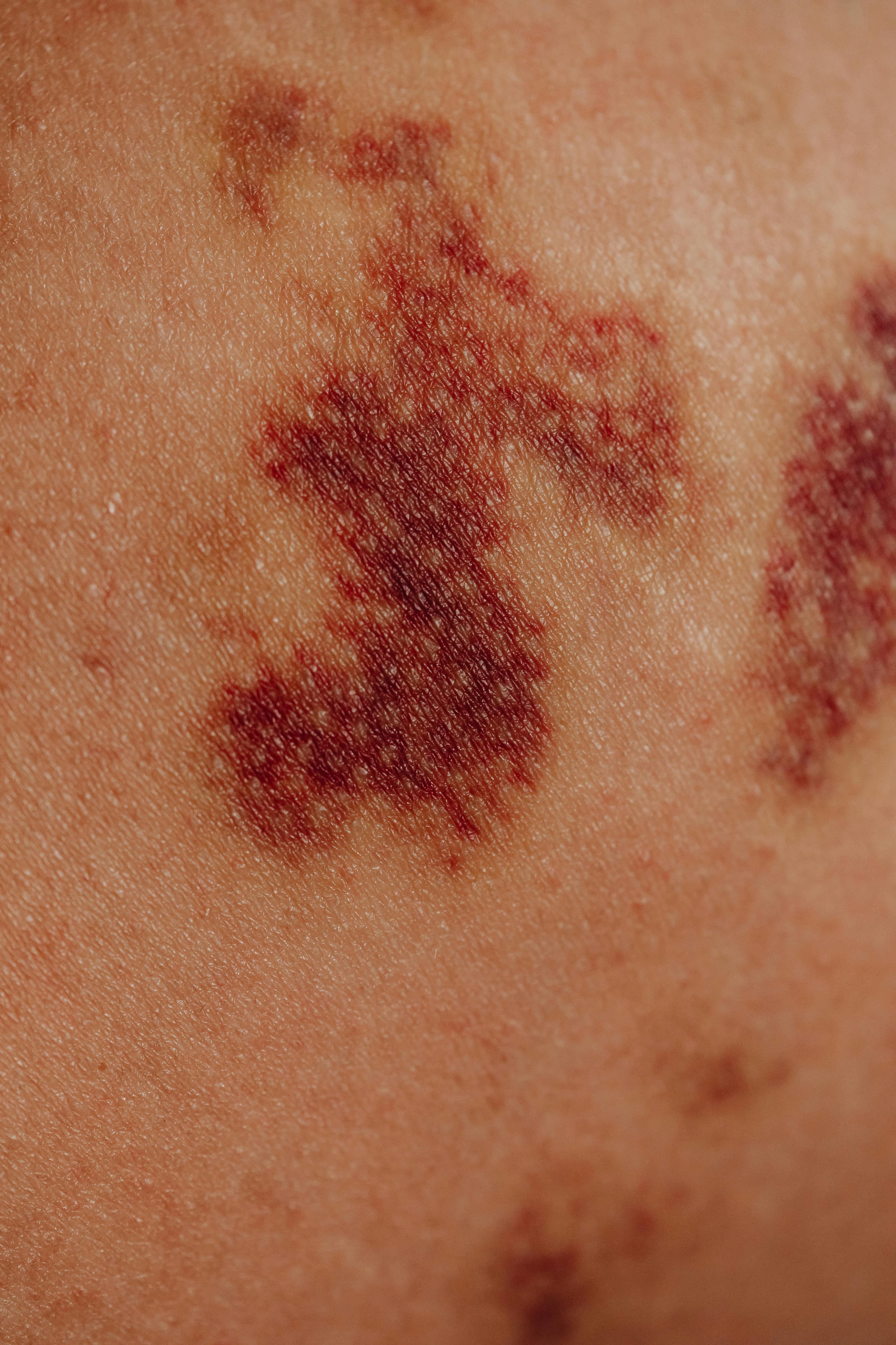 Close-up of a swollen lip with visible bruising, indicating a hematoma