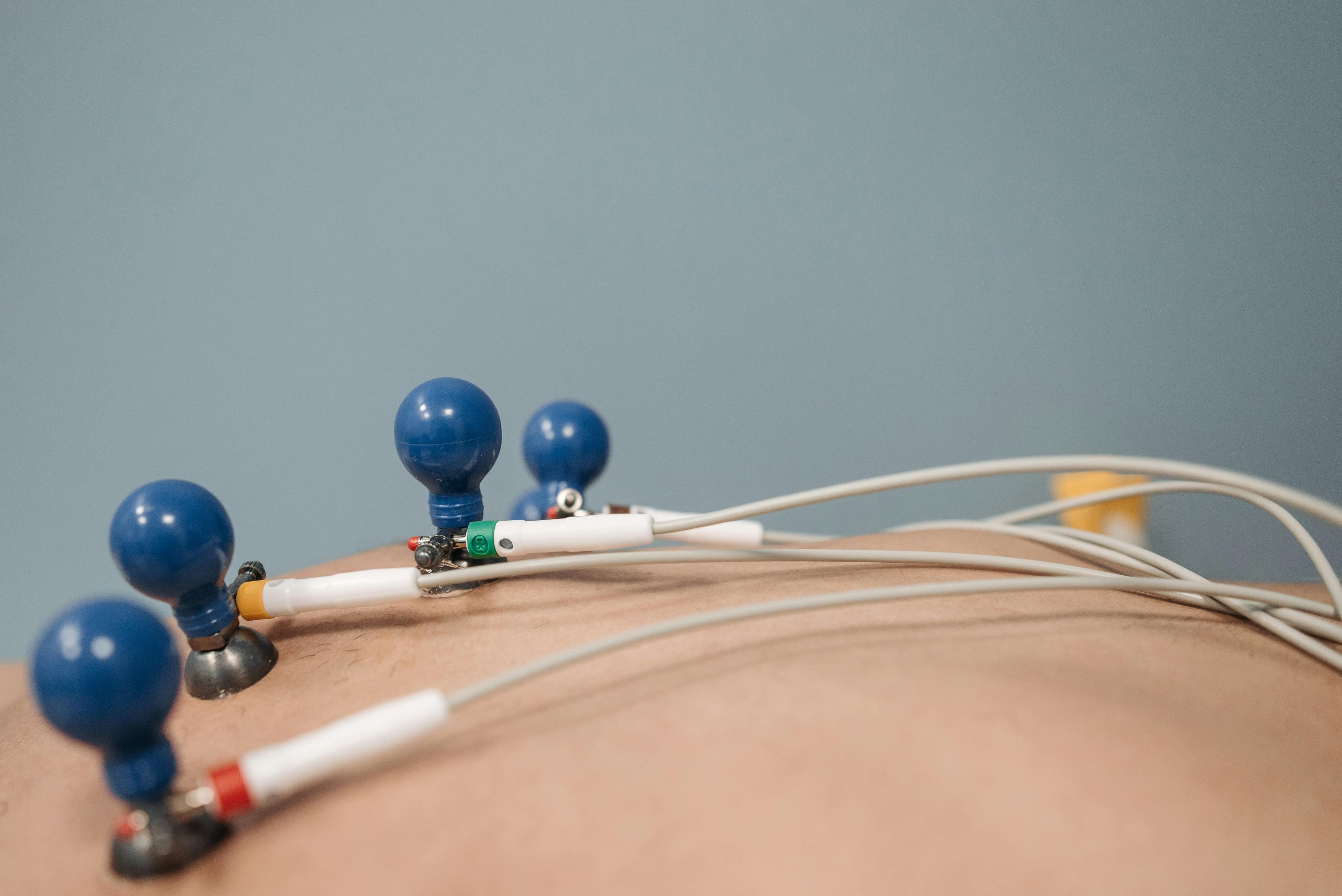 An ECG machine with leads attached to a patient's chest