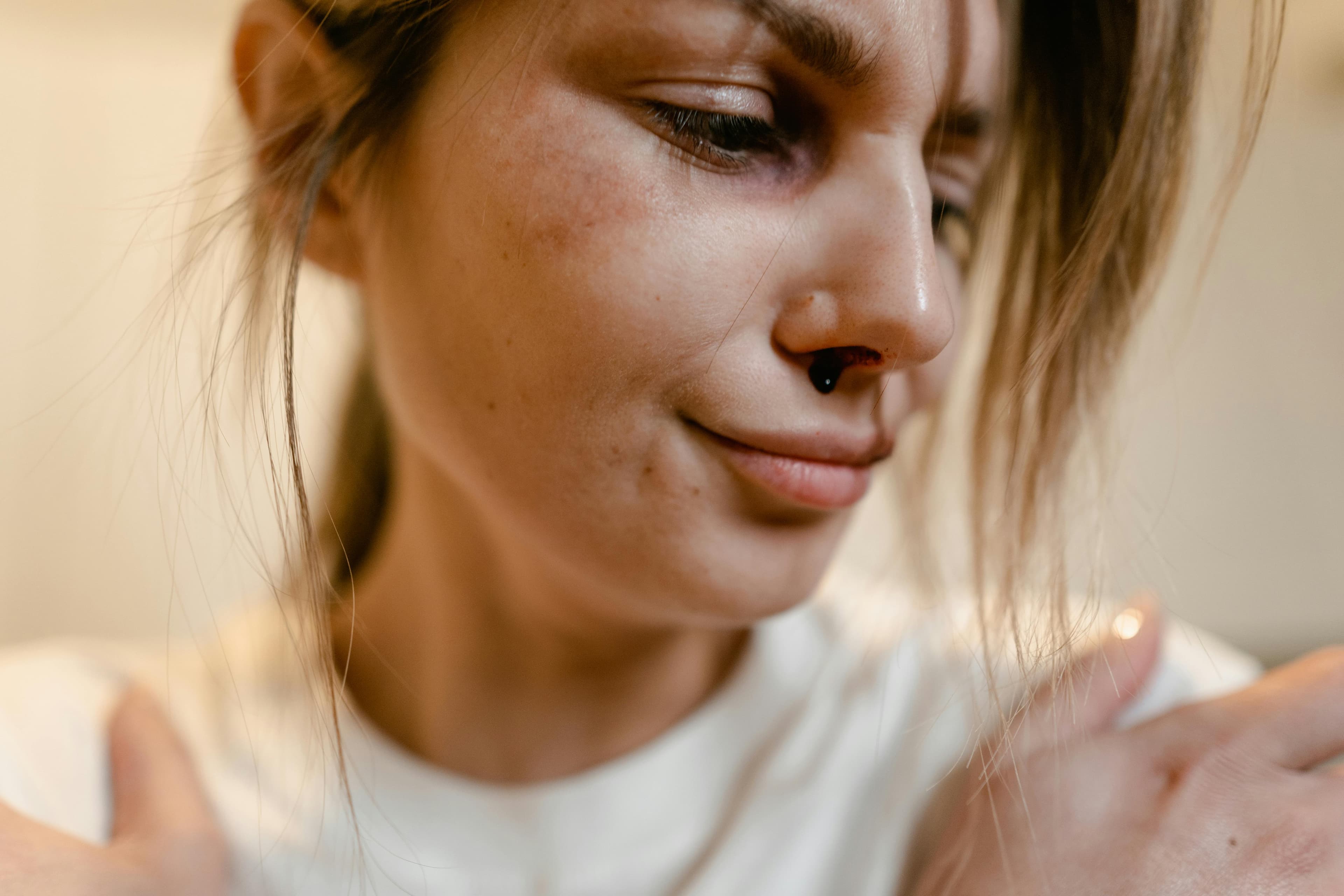 Close-up of a nose showing early signs of rhinophyma including redness and visible blood vessels