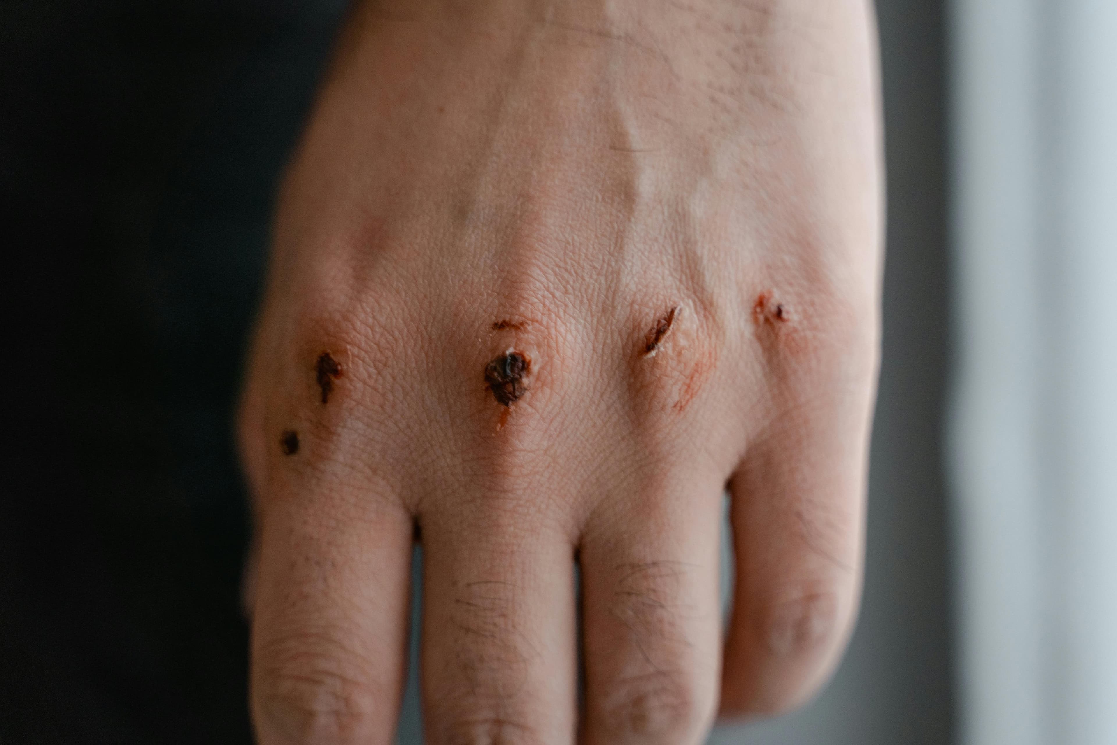 A hand with visible cuts or injuries, illustrating common causes of nerve damage on fingers