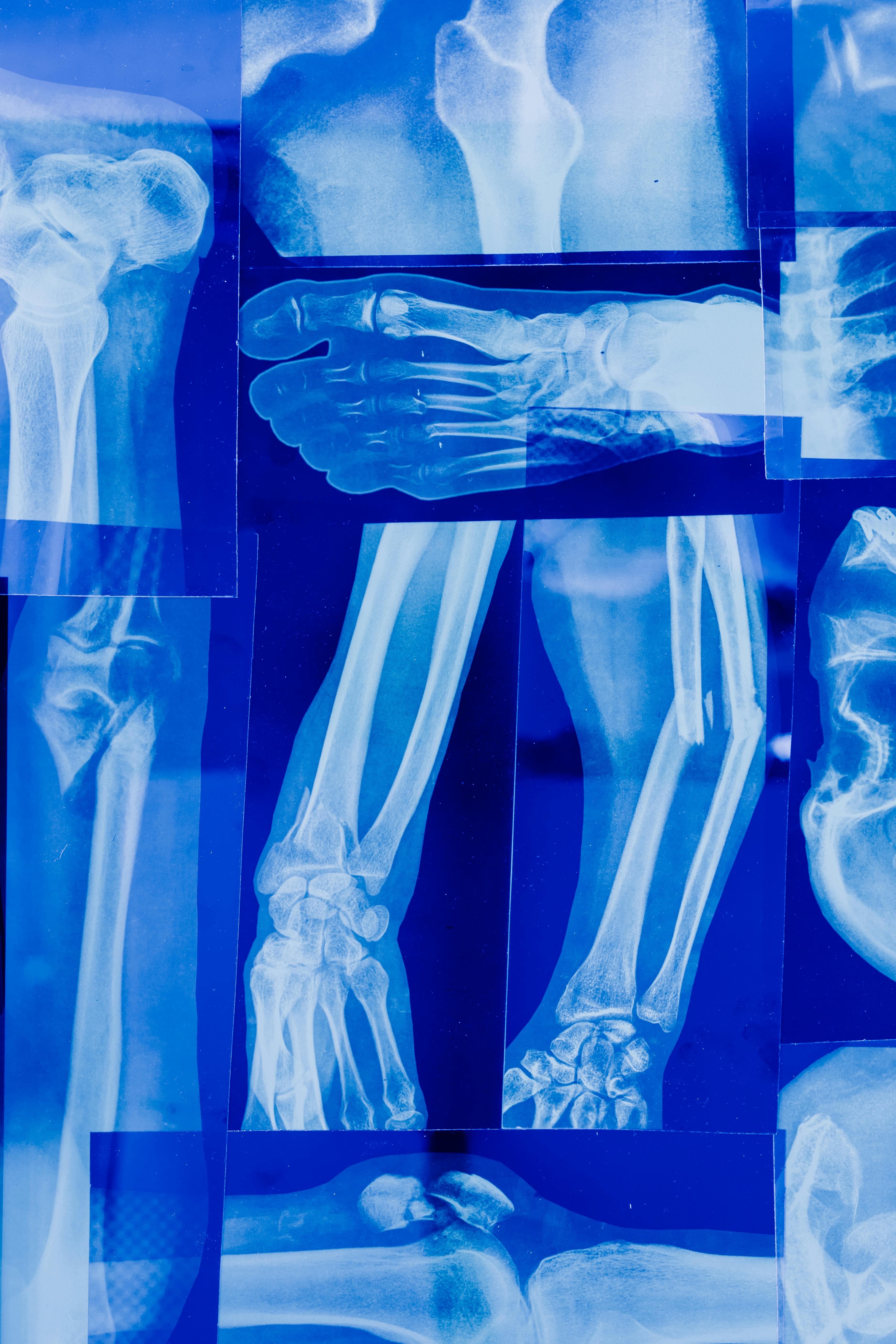 Various pain relief medications for broken bones including NSAIDs, opioids, and acetaminophen