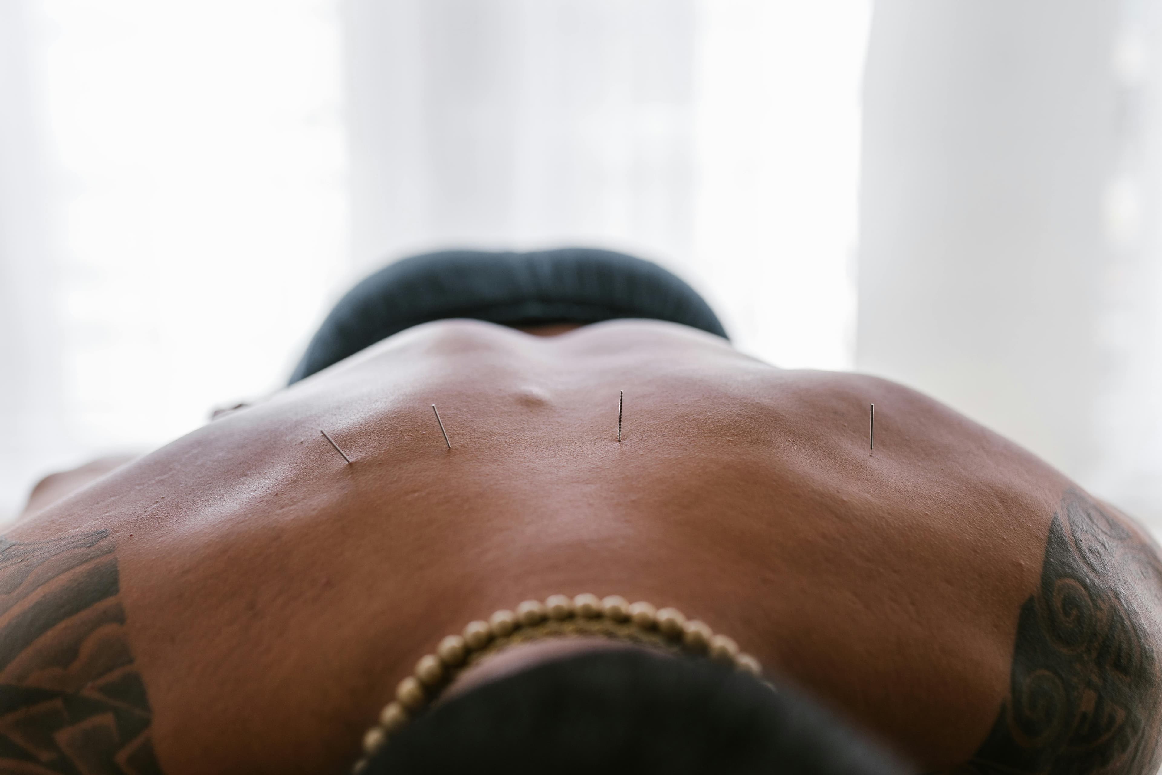 A patient receiving an acupuncture treatment with needles in their back