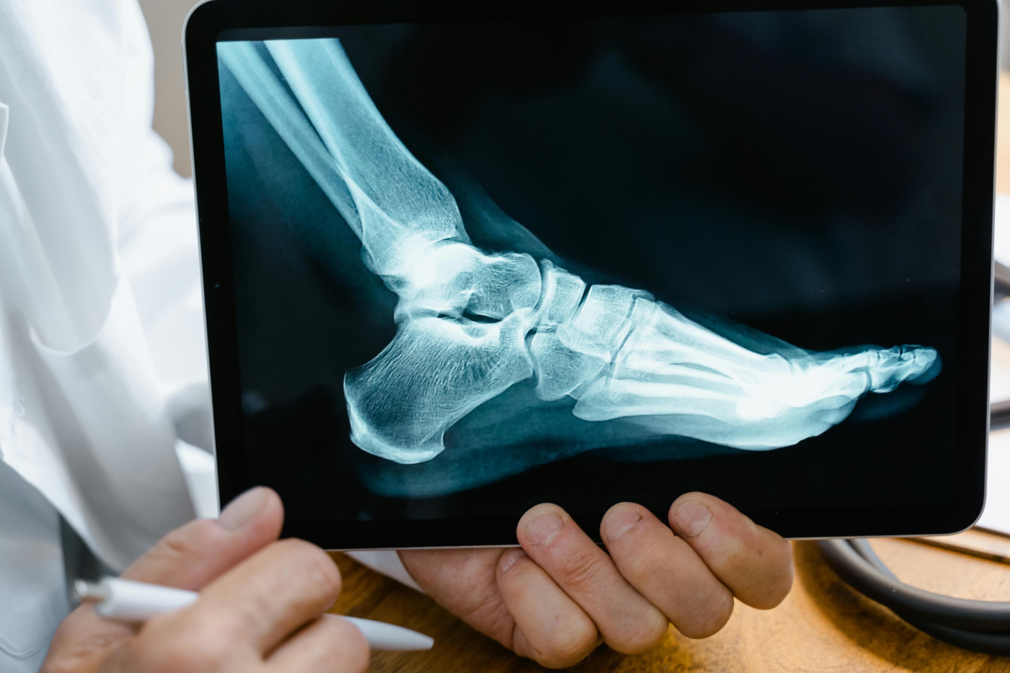 Diagram showing before and after bunion surgery on a foot