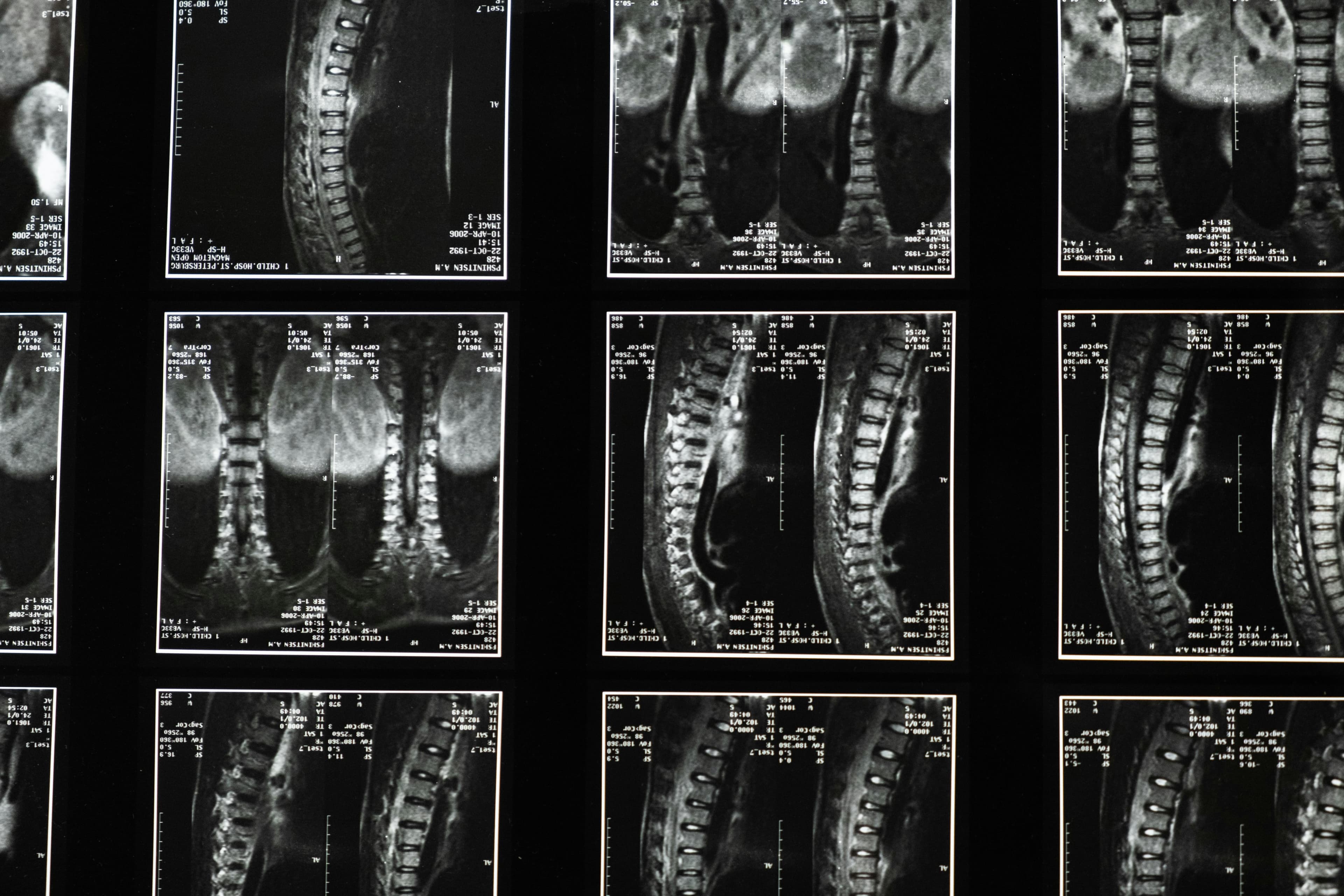 Diagram of the lumbar spine showing areas commonly affected by spondylosis