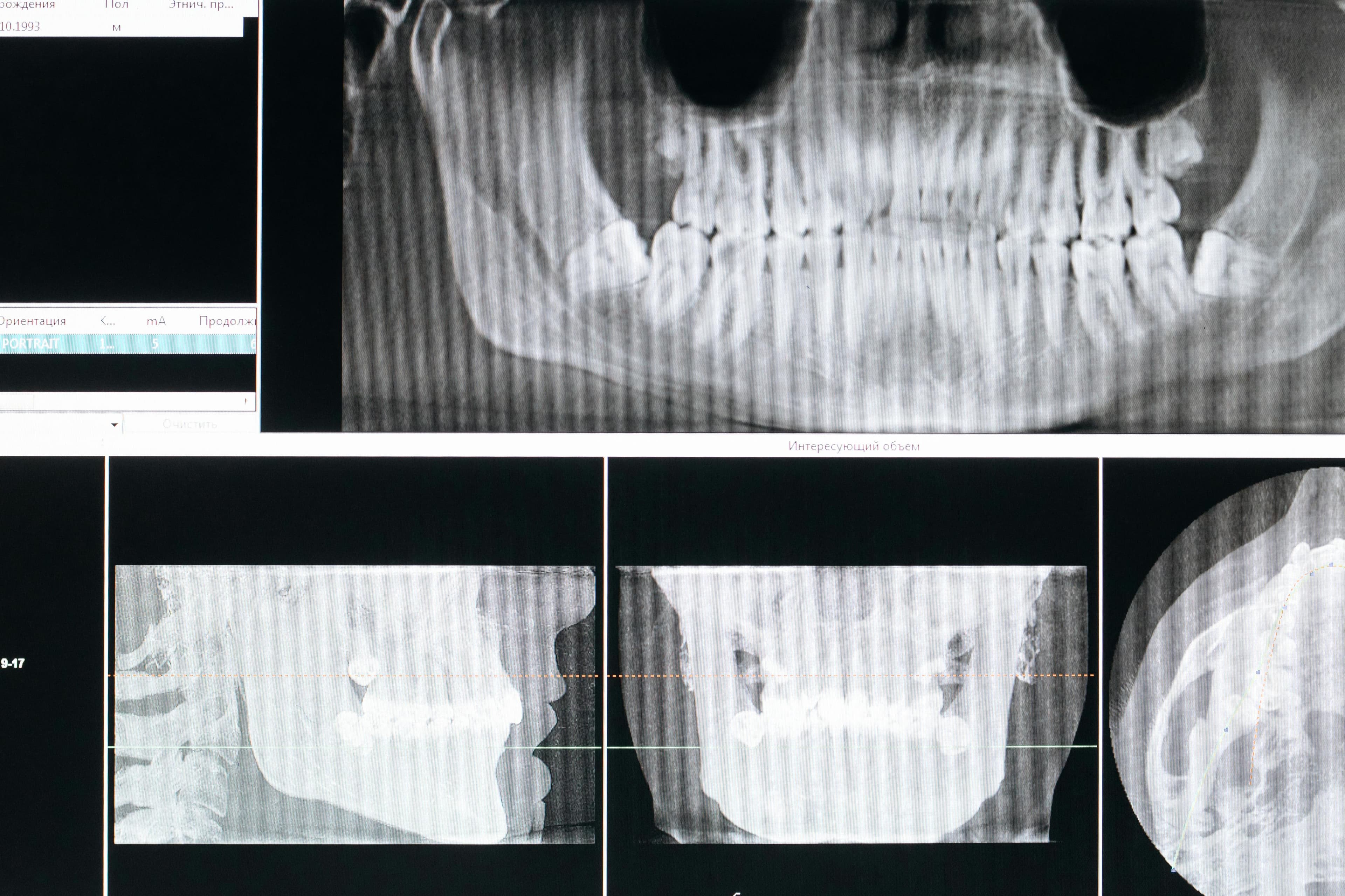 Before and after images of oral commissure rehabilitation
