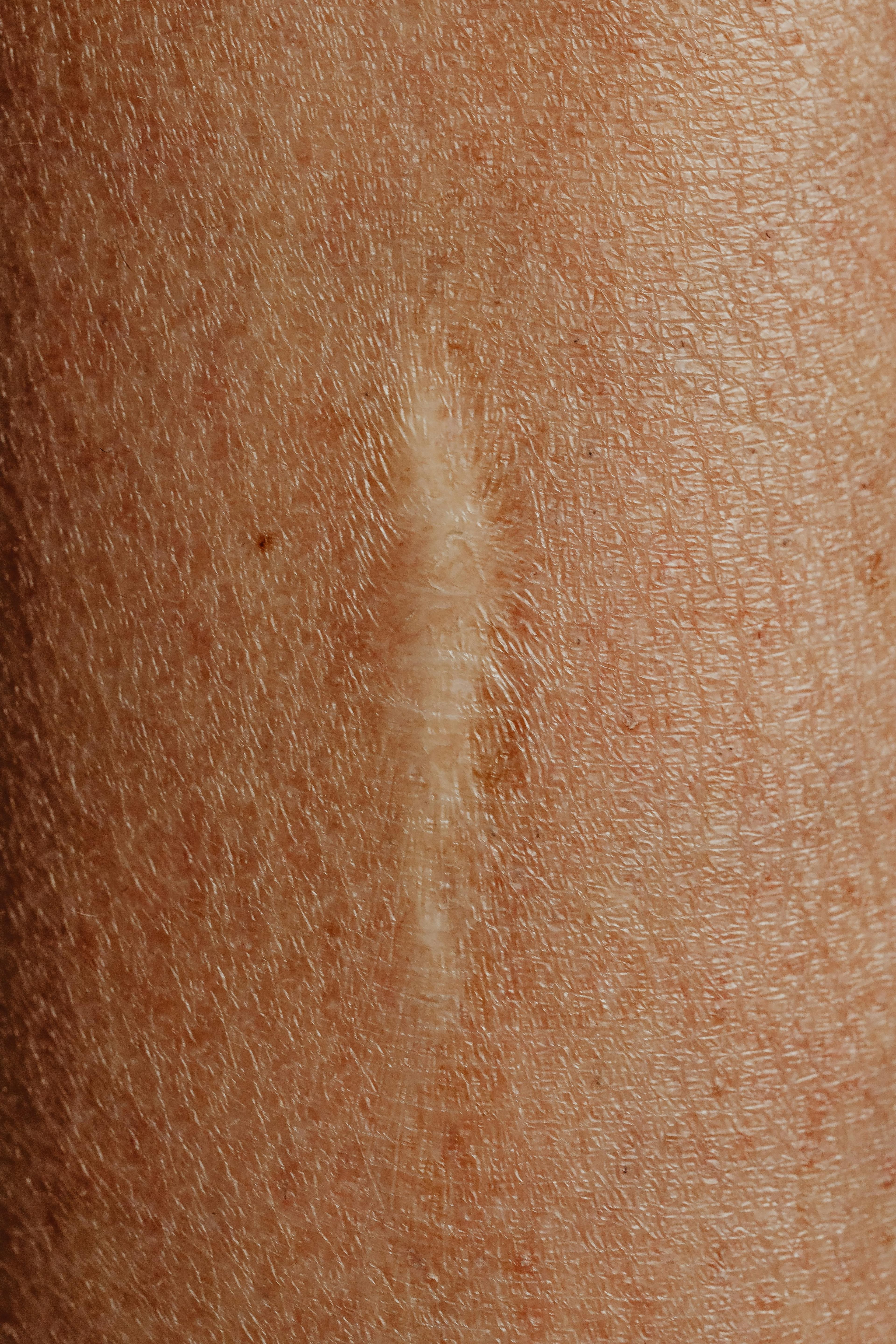 Close-up of an epidermal inclusion cyst showing a small central punctum on the skin surface